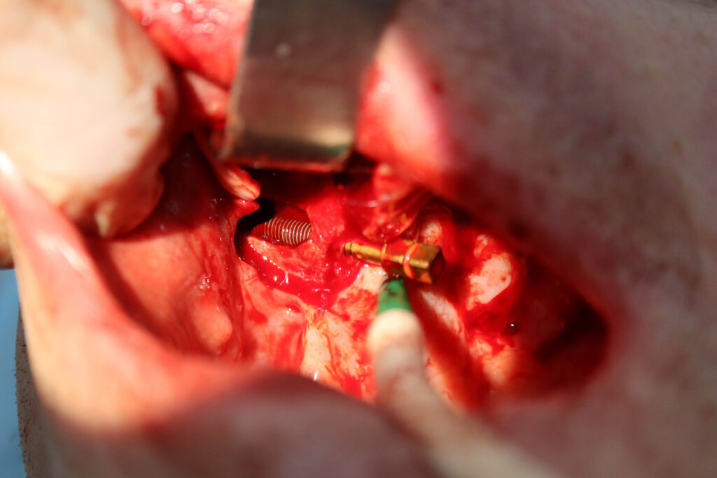 процесс имплантации