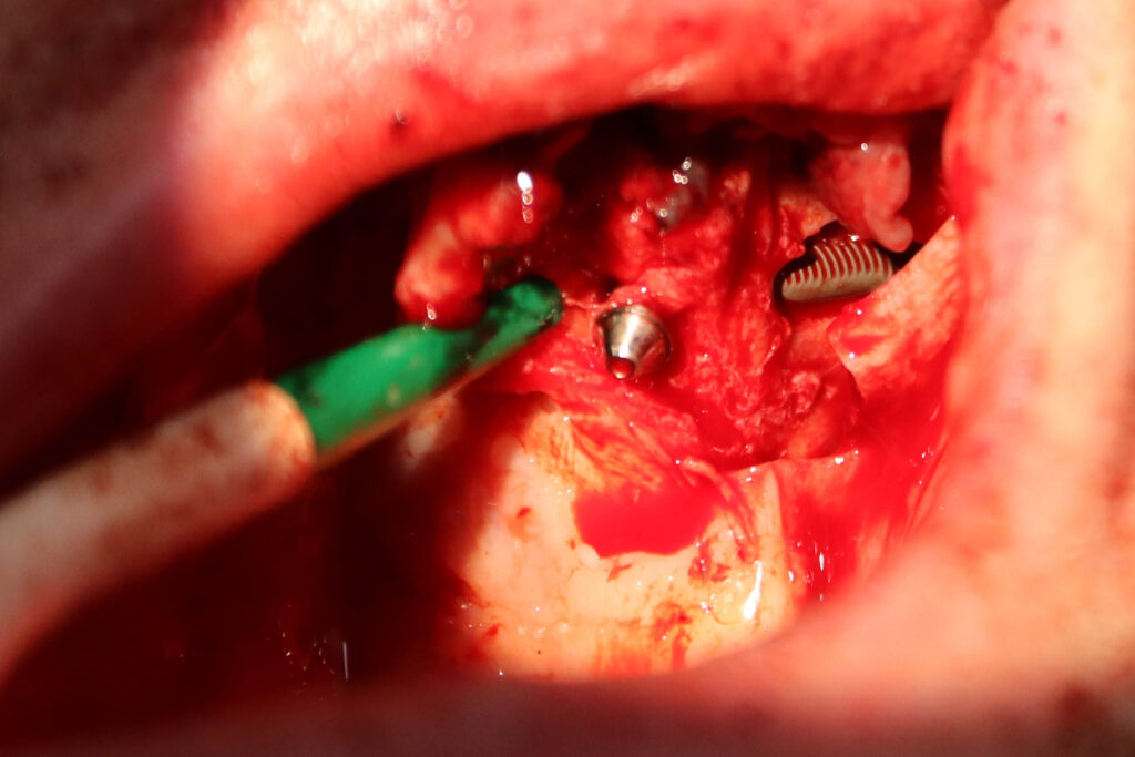 процесс имплантации