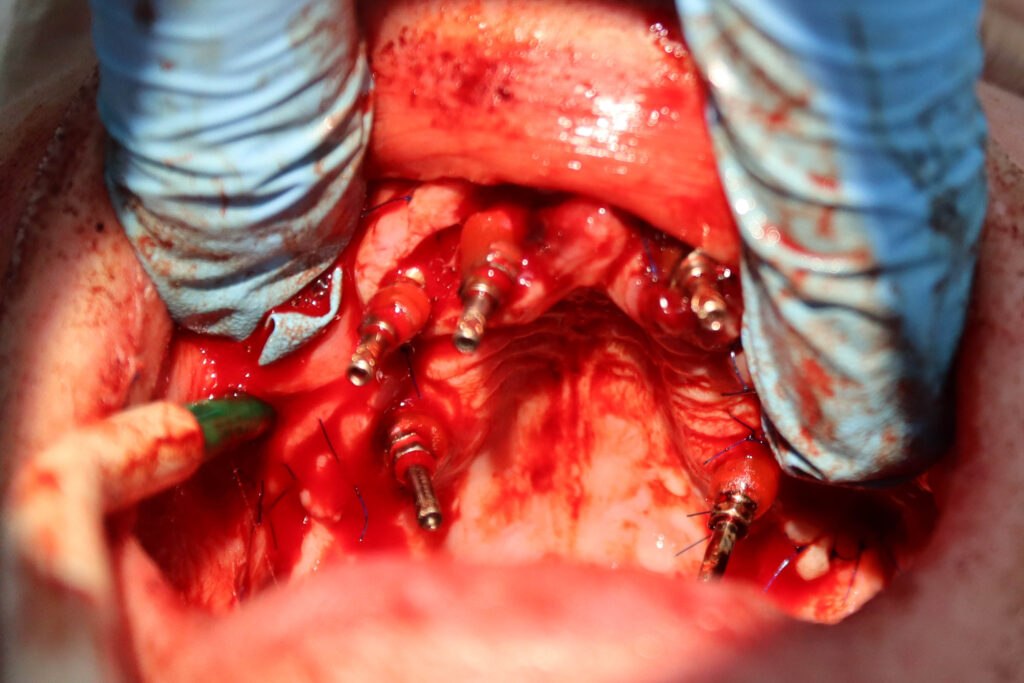процесс имплантации