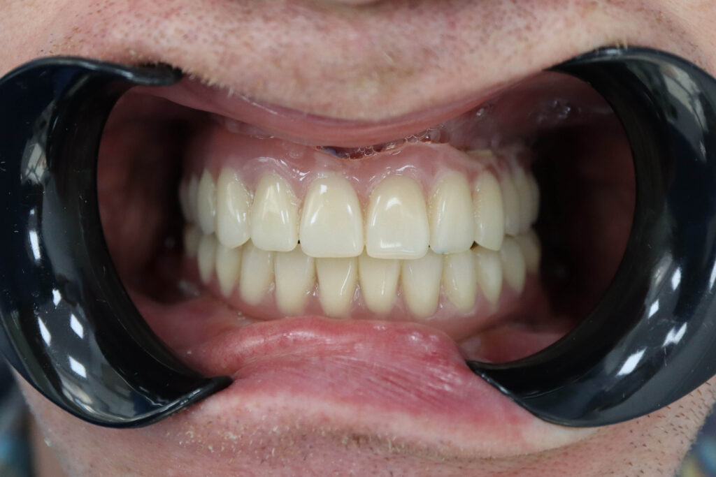 комплексная имплантация по системе All-on-5