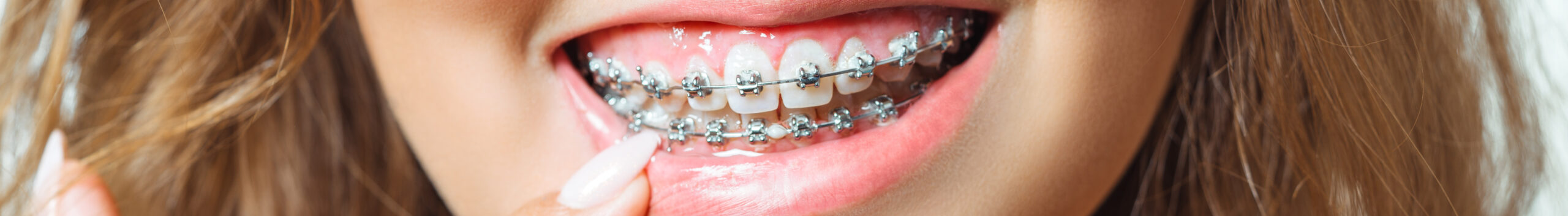 Виды ортодонтических конструкций из керамики