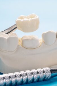 Коронки из пресс-керамики E-max