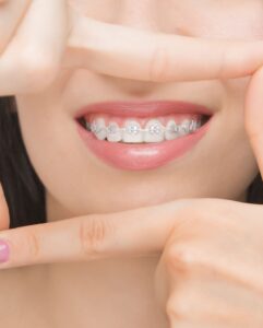 Керамические брекеты