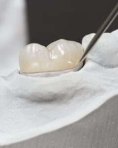 Зубные вкладки