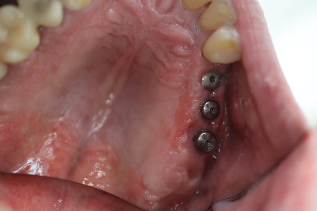 пациент до протезирования