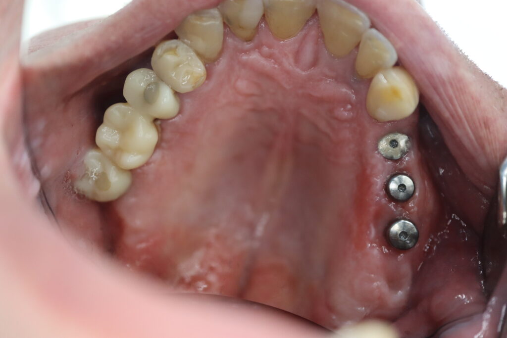 пациент до протезирования