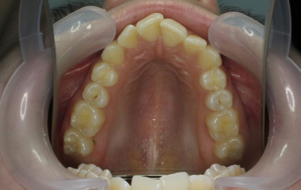 пациент до лечения брекетами