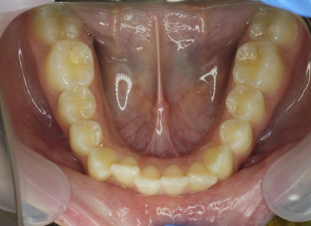 пациент до лечения брекетами