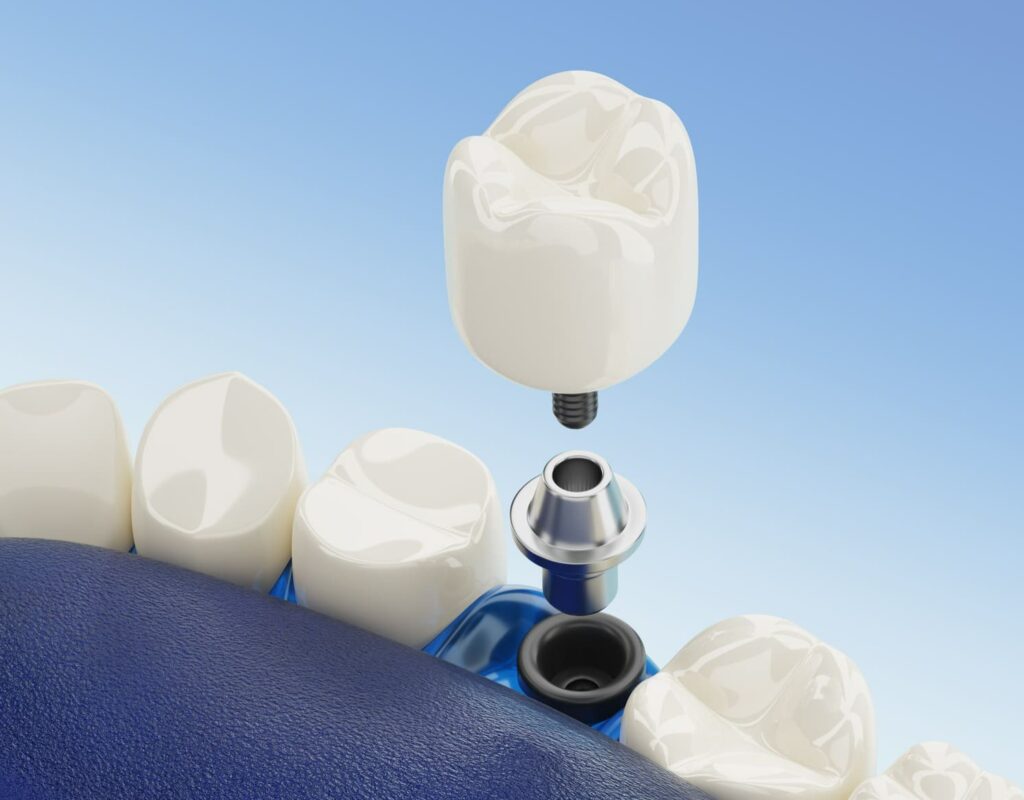 двухэтапная имплантация зубов