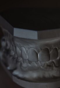 Синус-лифтинг