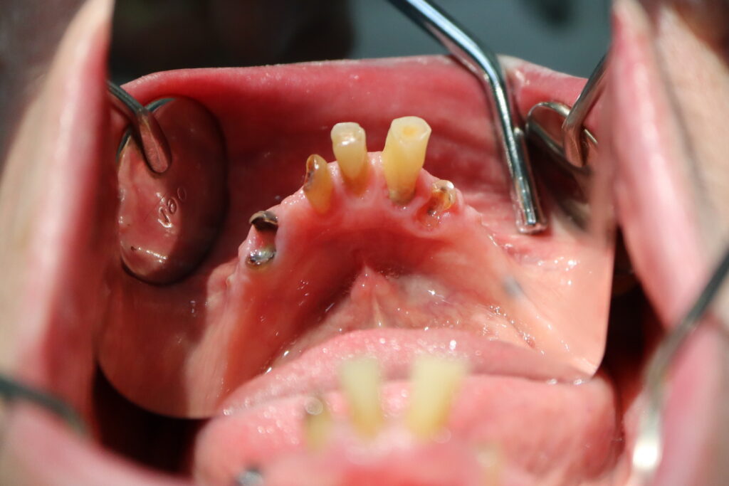 процесс имплантации