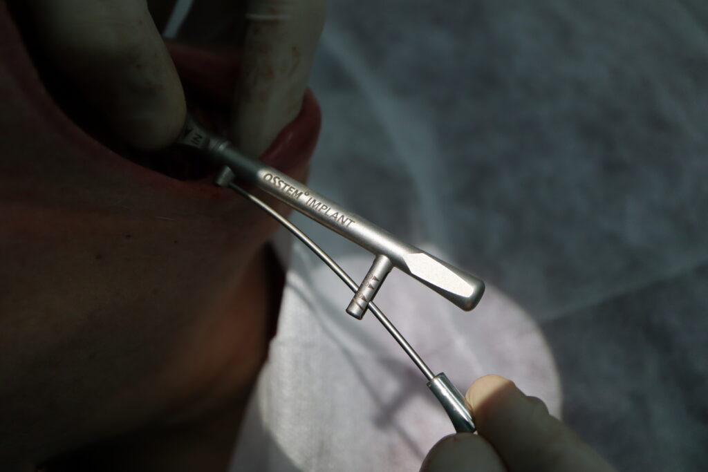 процесс имплантации