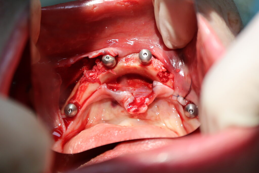 процесс имплантации