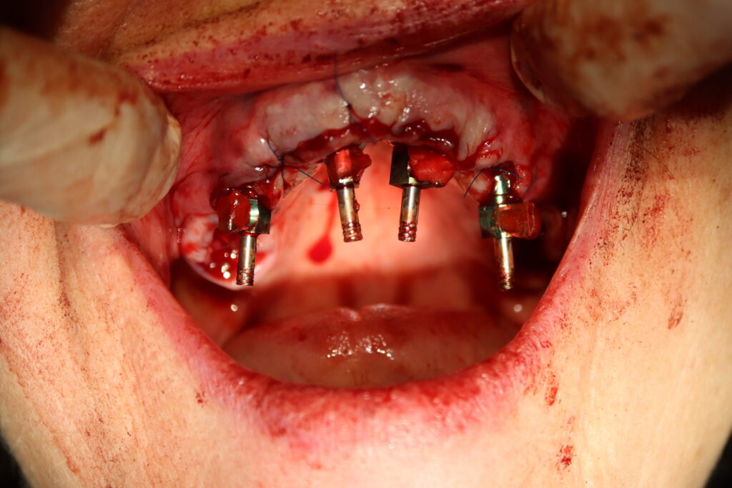 процесс имплантации
