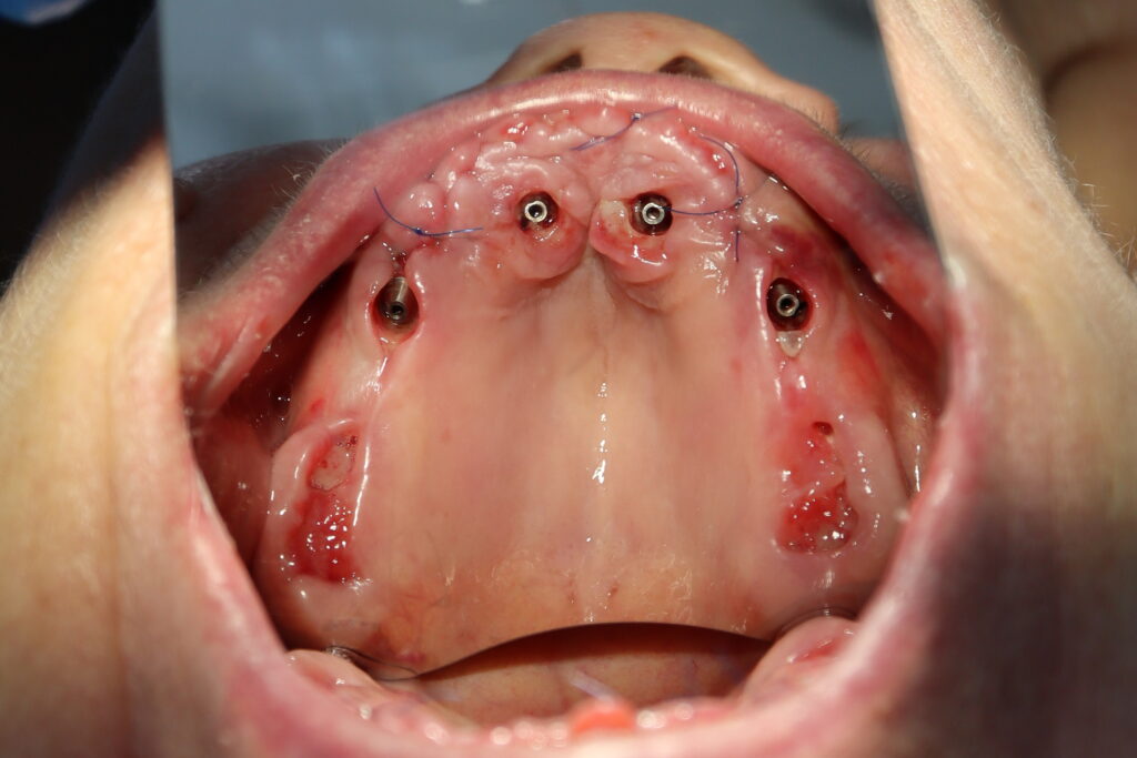 процесс имплантации