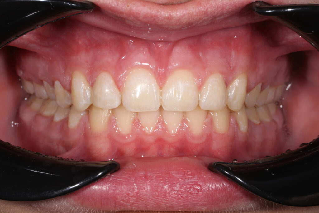 Установка брекет-системы Damon Q