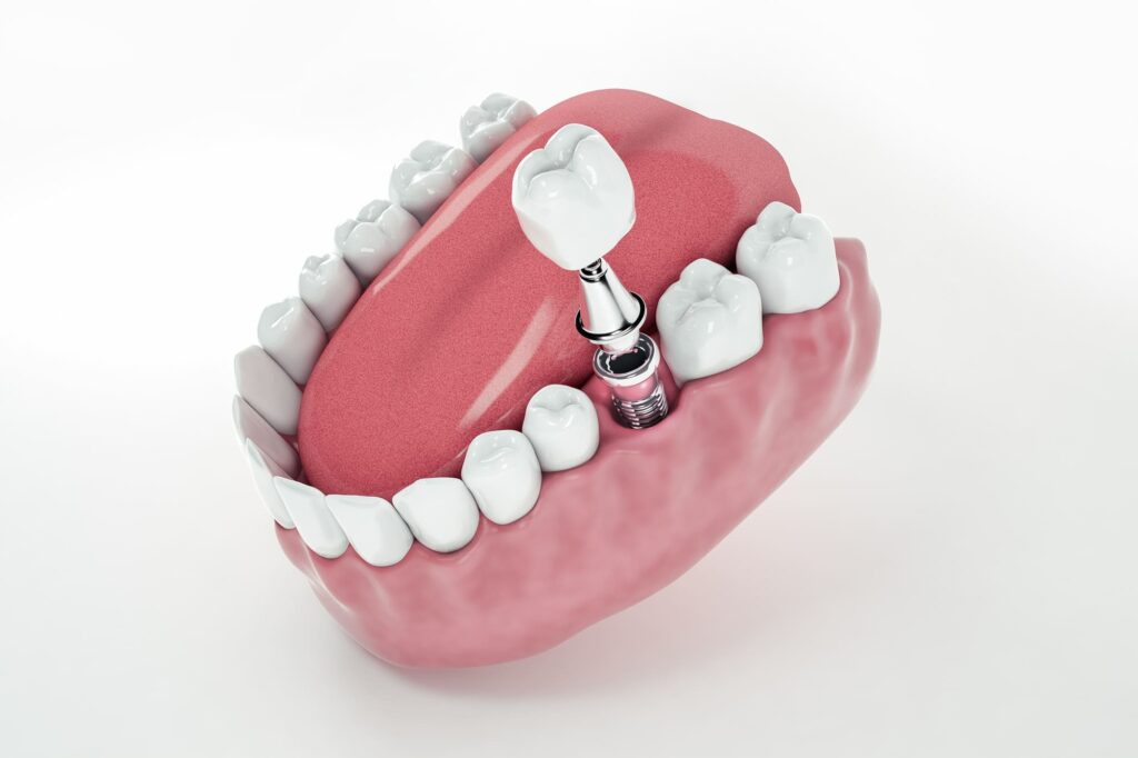 Имплантация зубов Megagen Any Ridge