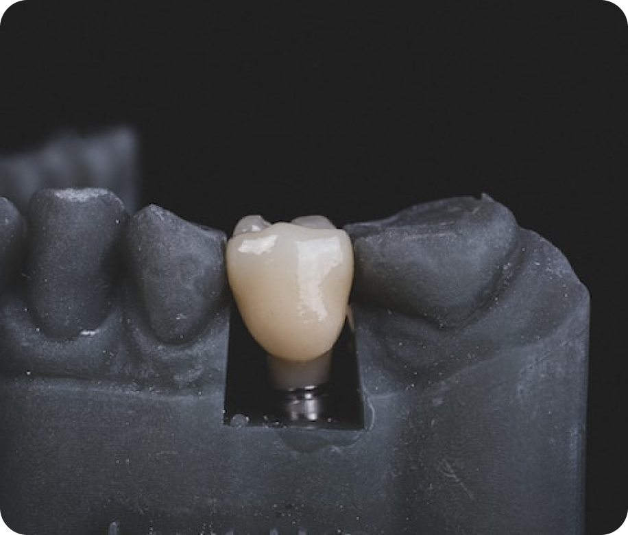 имплантация зубов в Бишкеке