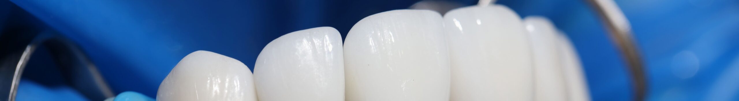 Этапы протезирования (установки коронок)