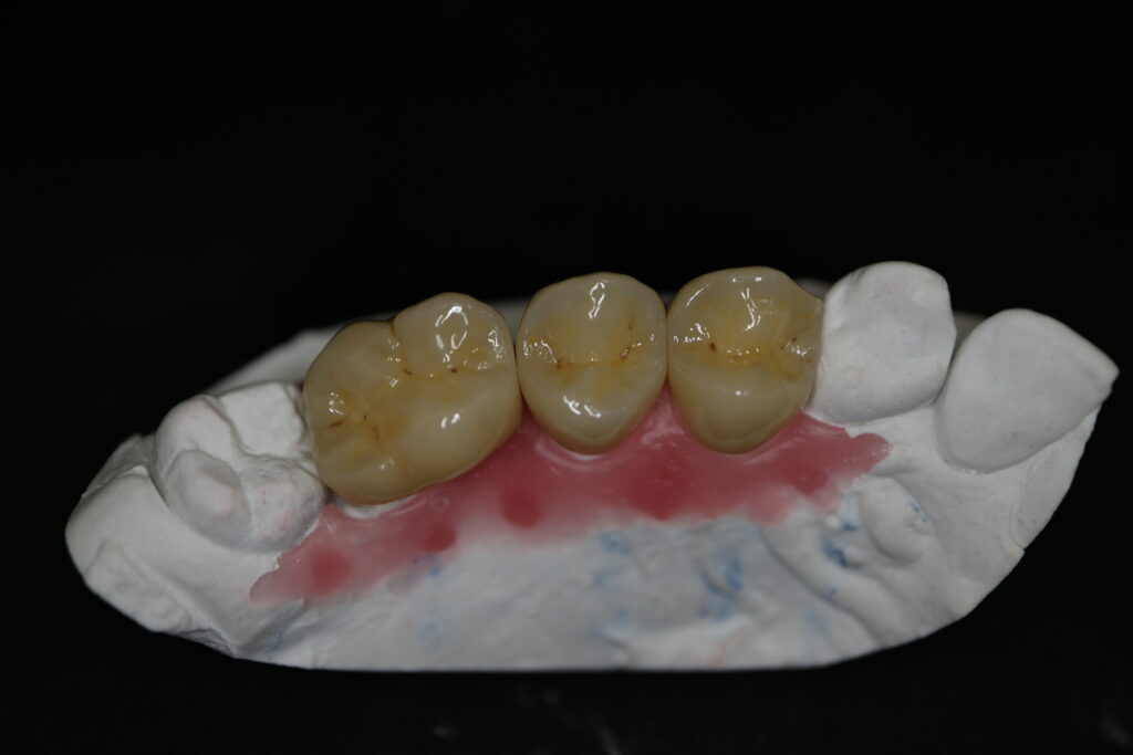 циркониевые протезы Cимпладент