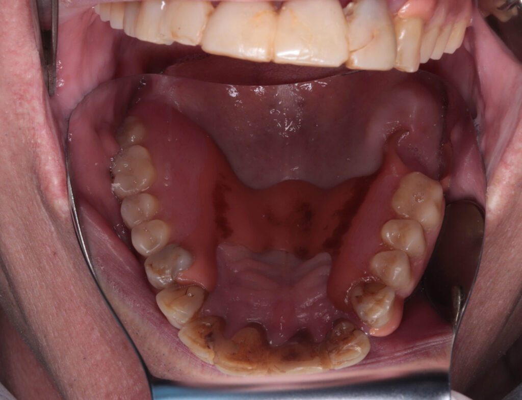 пациент до имплантации