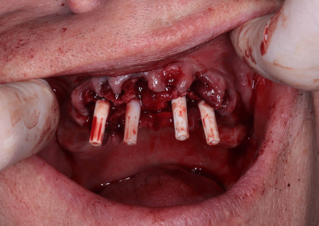 пациент по время имплантации