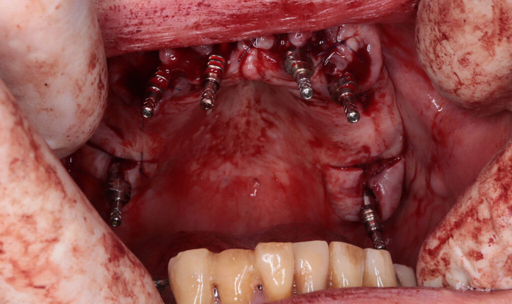 пациент по время имплантации