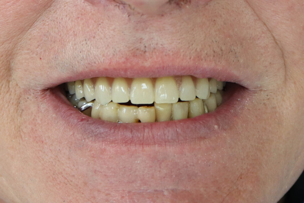 результат имплантации