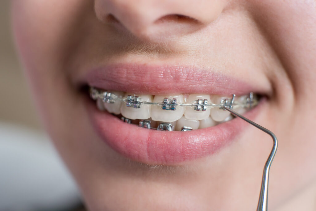 Способы фиксации брекетов