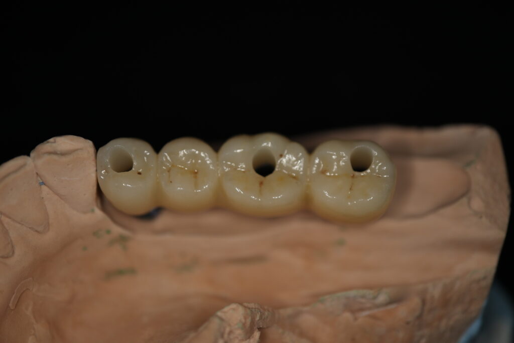 циркониевые протезы Cимпладент