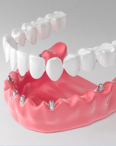 Несъемное протезирование зубов