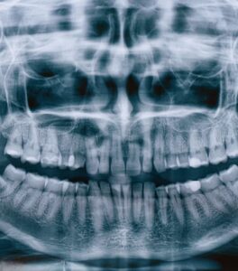 Рентгенодиагностика зубов