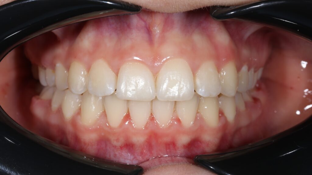 пациент после ортодонтического лечения