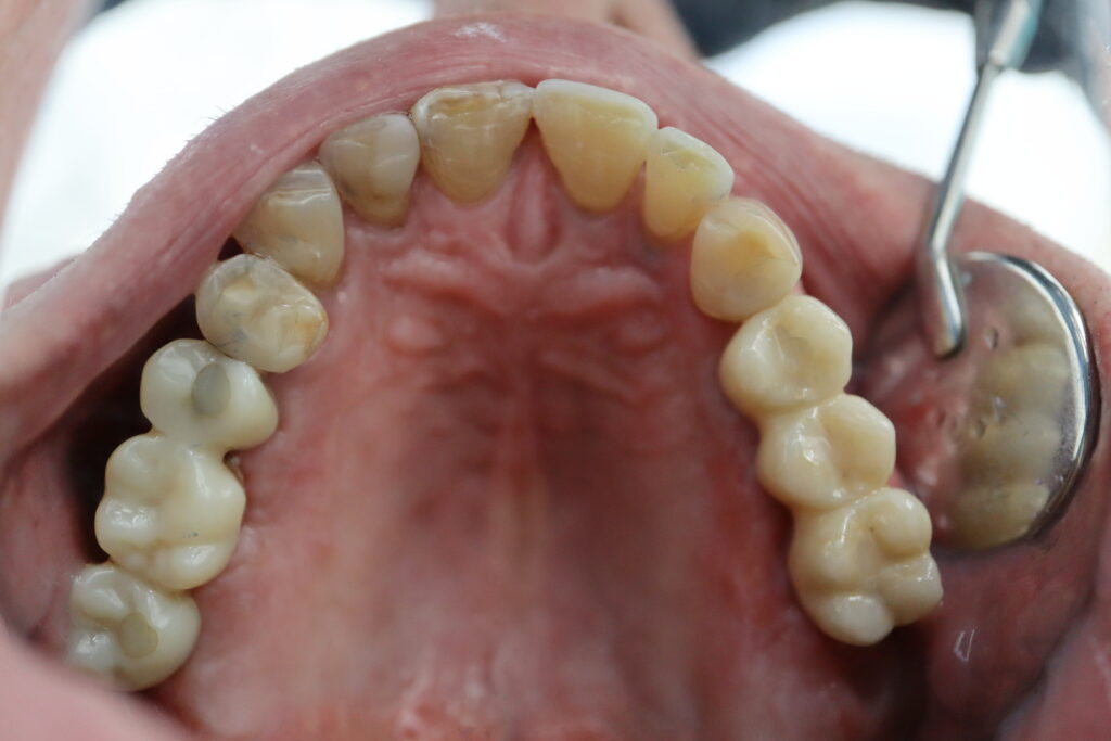 Протезирование мостом из диоксида циркония на винтовой фиксации с опорой на 3 имплантата Mis C1