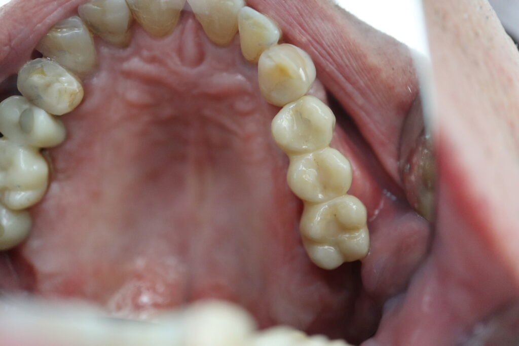 результат протезирования