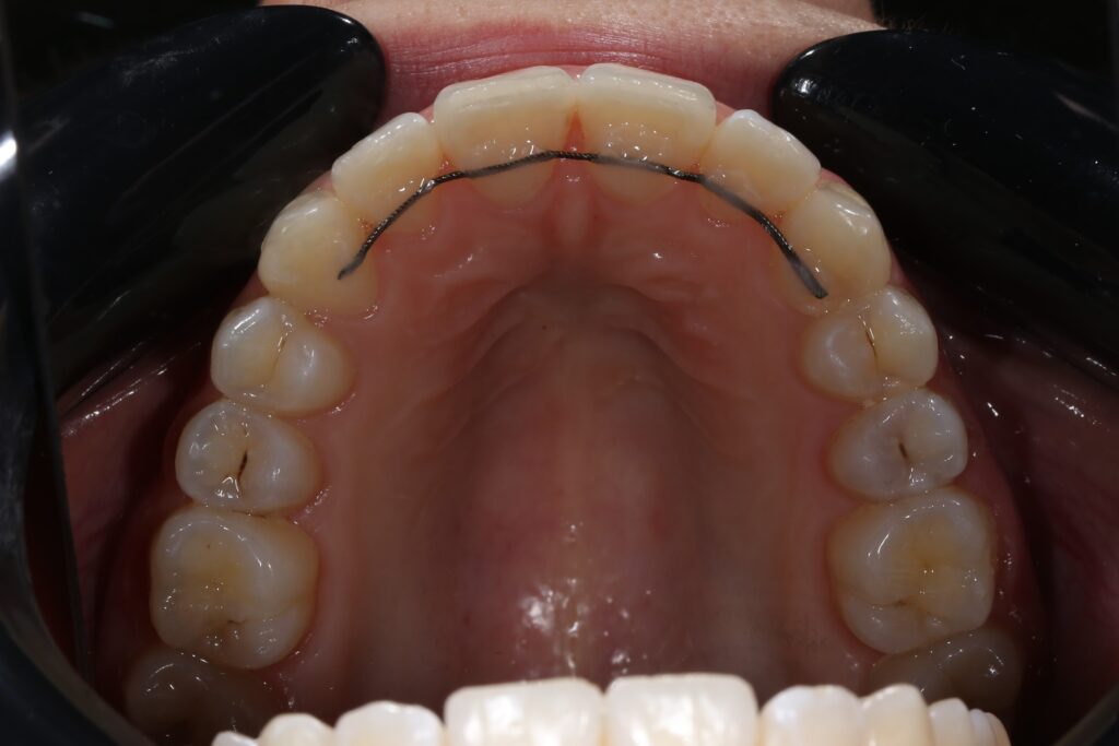 пациент после ортодонтического лечения