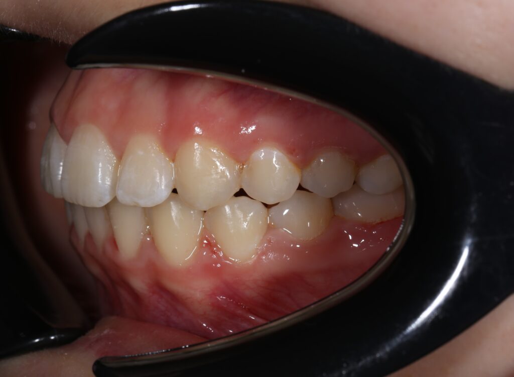 пациент после ортодонтического лечения