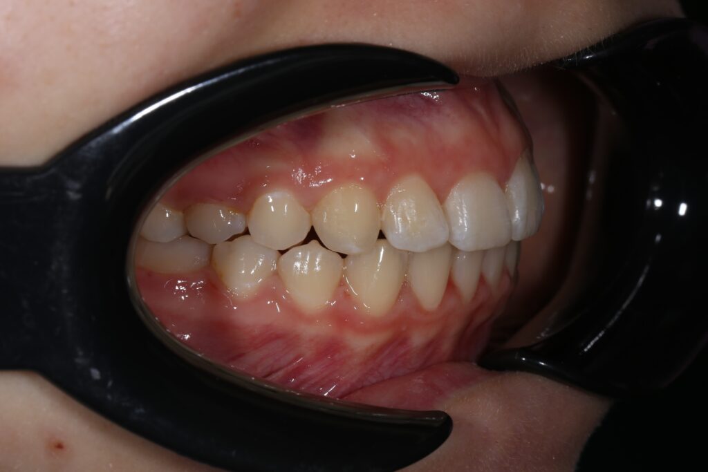 пациент после ортодонтического лечения