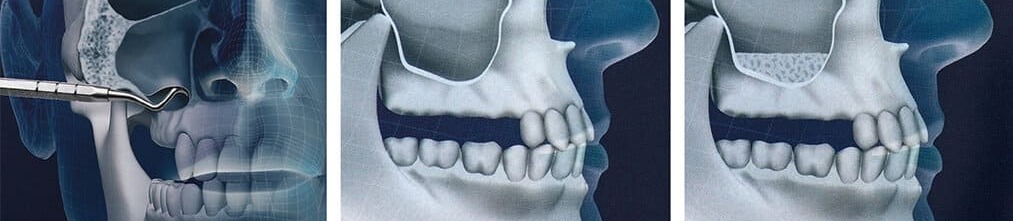 Виды синус-лифтинга