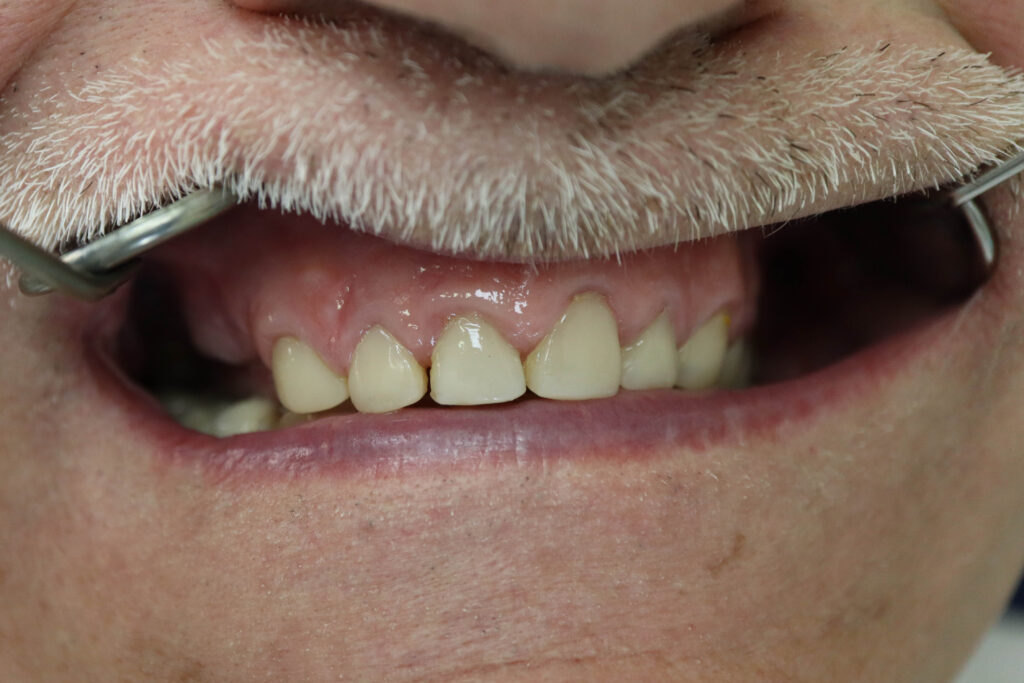 пациент до имплантации