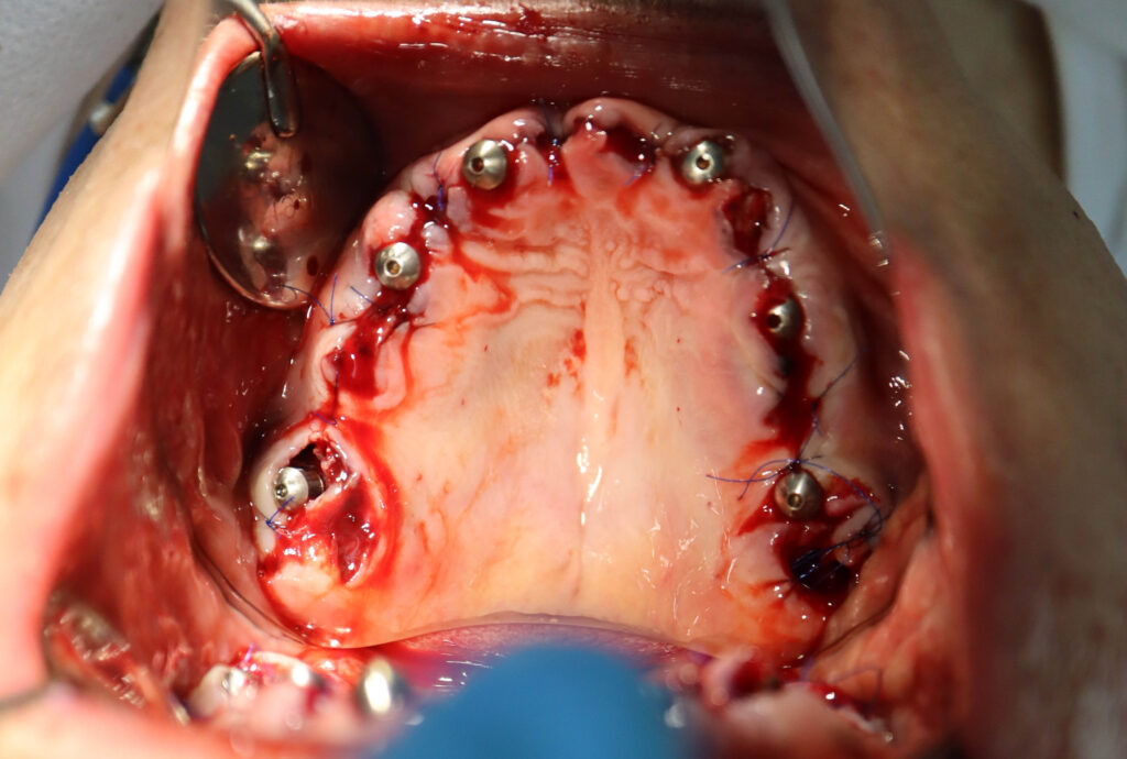 в процессе имплантации