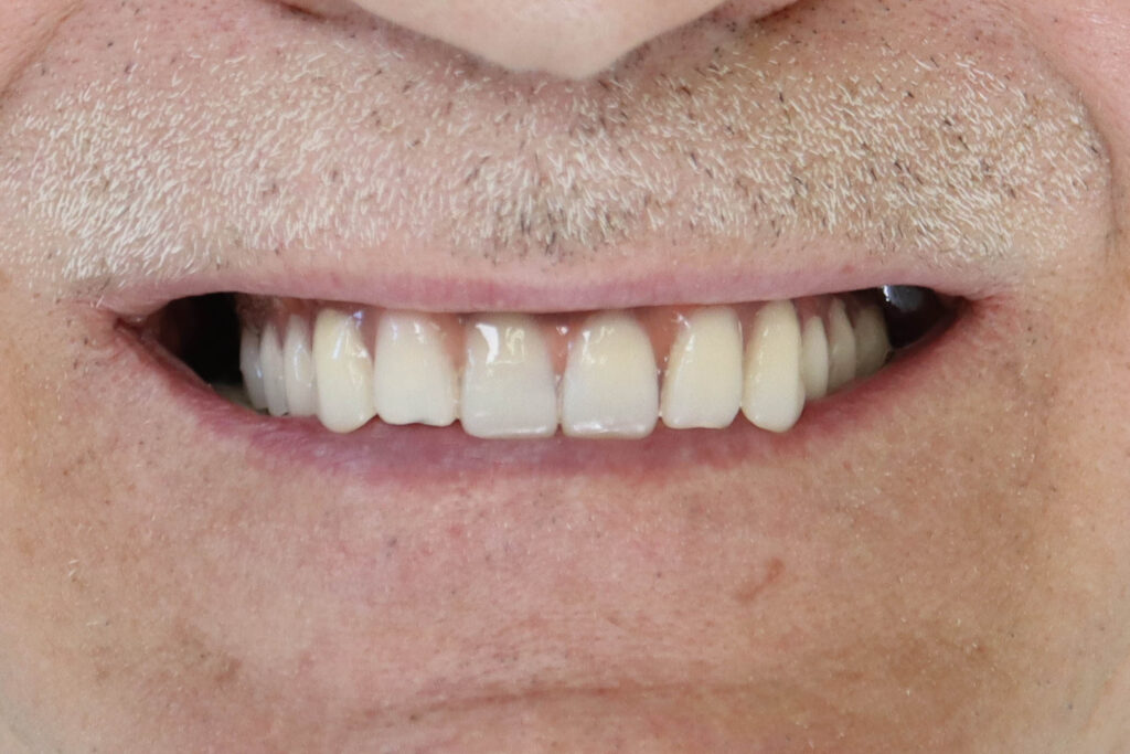 рузультат имплантации