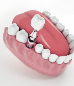 Имплантация зубов Megagen Any Ridge