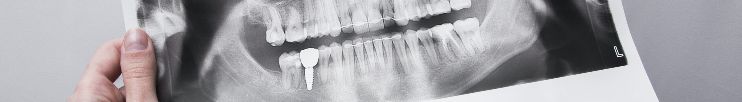 Виды рентгенодиагностики зубов и их отличия