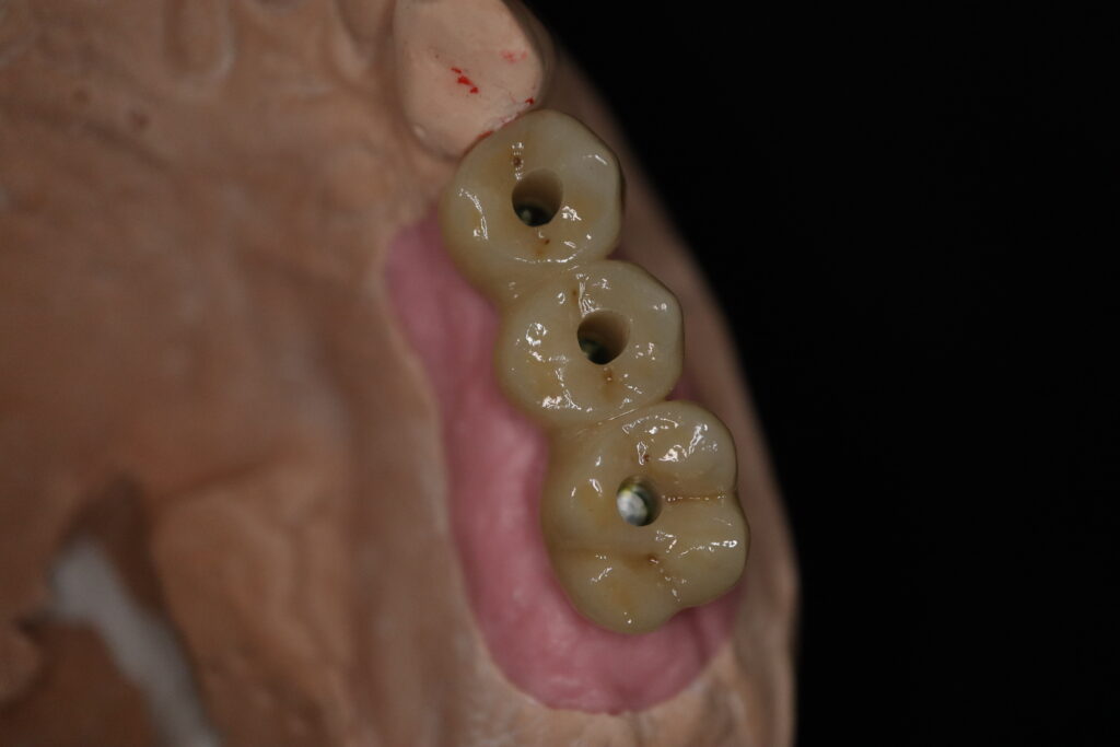 процесс протезирования