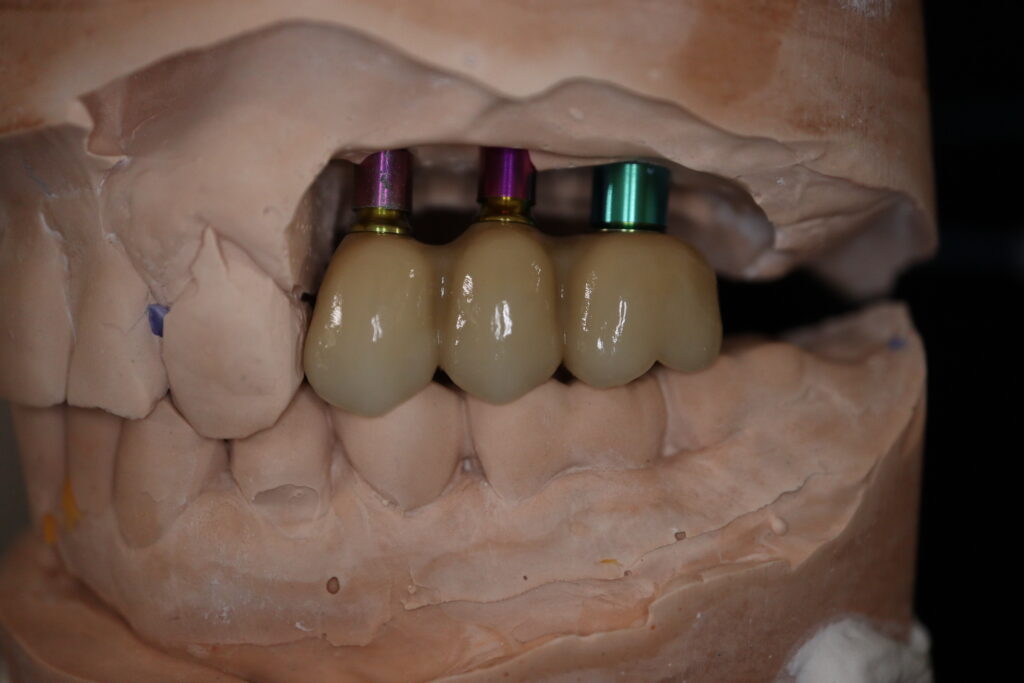 процесс протезирования