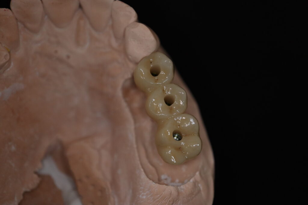 процесс протезирования