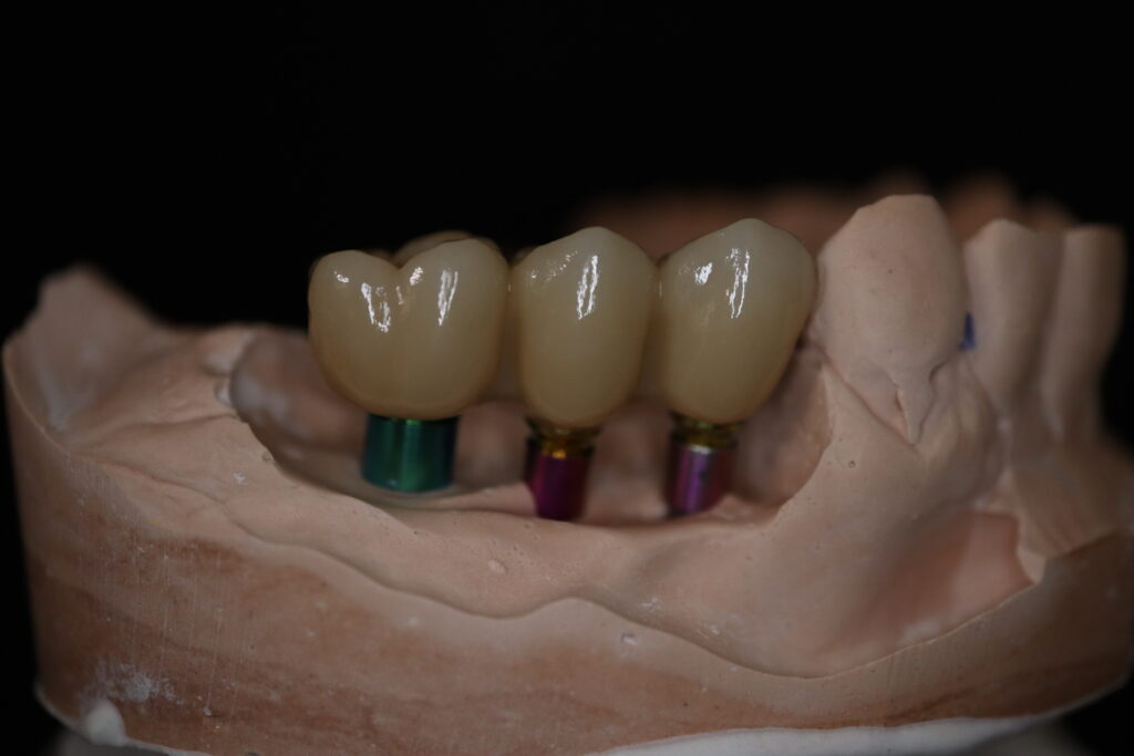 процесс протезирования