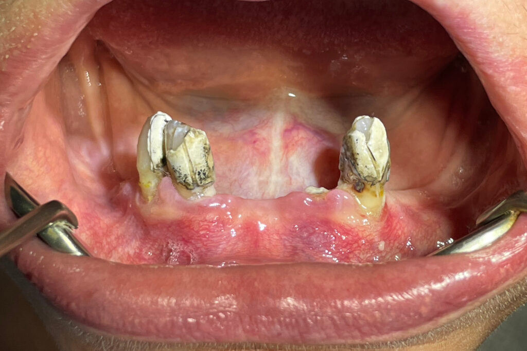 пациент до имплантации