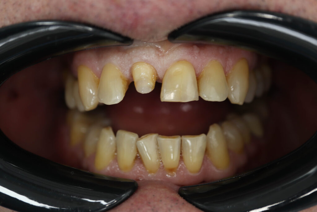 пациент до протезирования